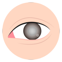 Cataract surgery