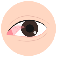 Plastic surgery for pterygium