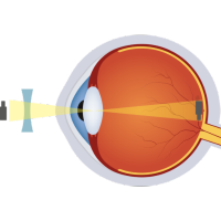 Retinal treatment