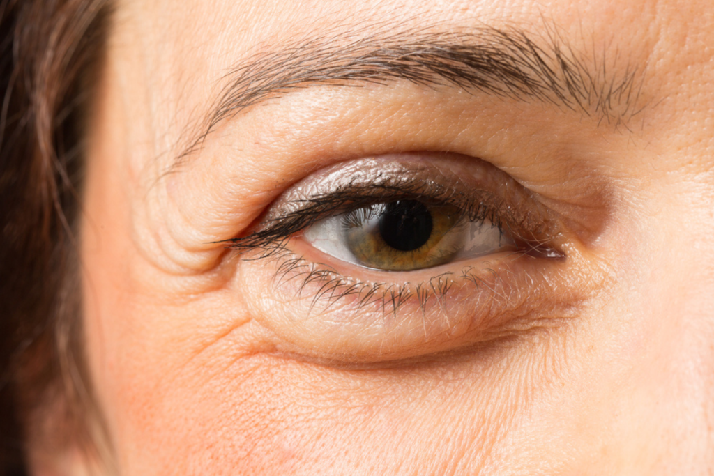 Eyelid malposition correction