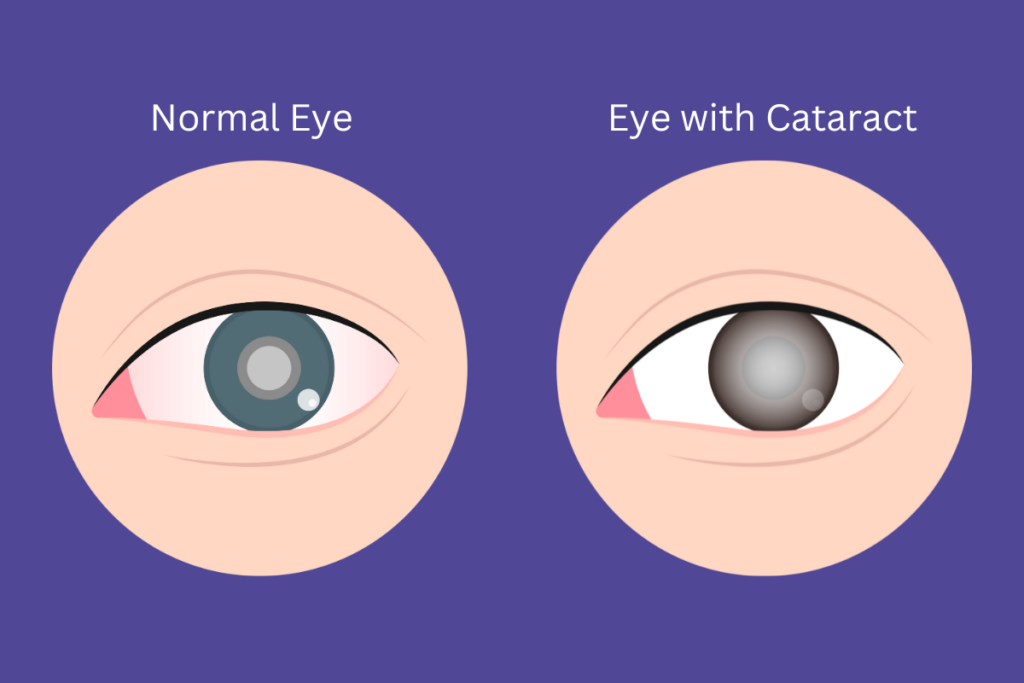 Cataract