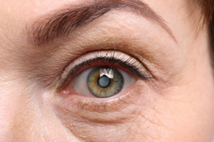 Cataract & Diabetes: Symptoms, Causes & Treatment