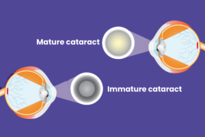 Difference between mature & immature cataract