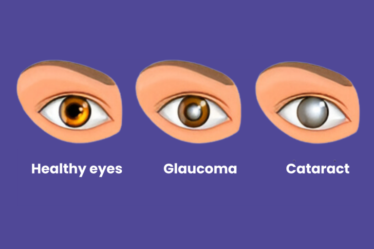 Glaucoma vs. Cataracts What's the difference