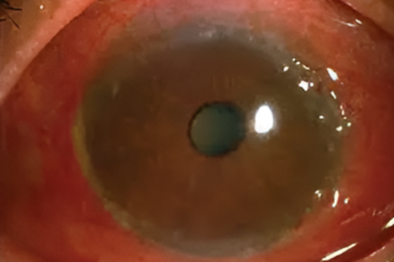 immature cataract