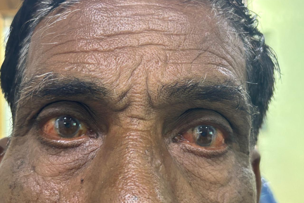 Pterygium