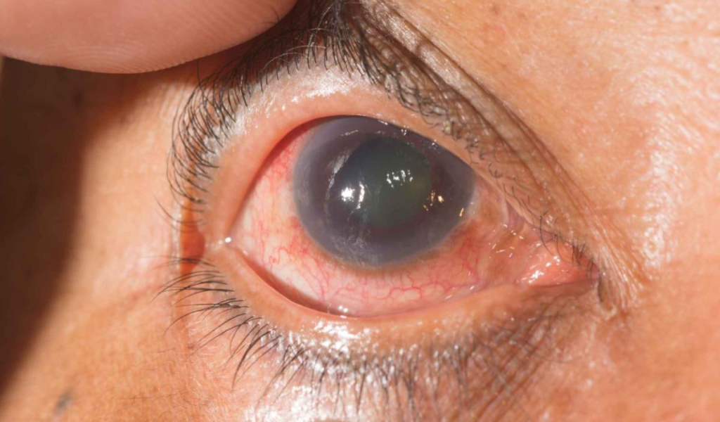 Glaucoma treatment in Ahmedabad